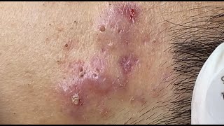 Hematoma Inflammation Acne HoangMySpa87 [upl. by Solhcin]