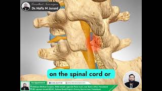 Lumbar Laminectomy Relieve Spinal Nerve Pressure  Dr Hafiz M Junaid Explains [upl. by Fortunato907]