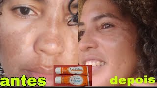 azelan gel antes e depois minha experiênciacom ácido azelaico 200mg [upl. by Ratep]