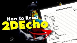 2DEcho  How to READ 2DEcho report  Echocardiography • Daily Cardiology [upl. by Gaw]