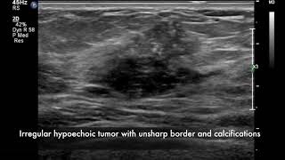 Breast ultrasound  cancer [upl. by Sivrup]