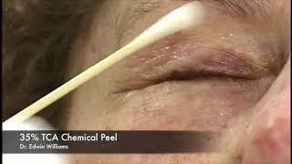 35 TCA Chemical Peel by Dr Edwin Williams for Wrinkles amp Sun Damage [upl. by Lenoj]