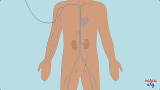 Traitement des varicocèles par embolisation  Chirurgie vasculaire miniinvasive [upl. by Eendys]