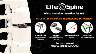 Micro Invasive Expandable Spacer TRULIFT® [upl. by Lark949]