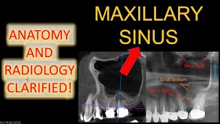 ALL Maxillary Sinus Anatomy 3D CBCT Mucosal Thickening in x ray OPG easy maxillary sinusitis lecture [upl. by Itin]