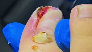 Remove a ROTTEN Toenail to Find a HUGE Ingrown Nail [upl. by Esirtal801]