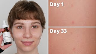 The Ordinary Ascorbic Acid 8  Alpha Arbutin 2 Dark Spots Results  1 Month with Pictures [upl. by Grosmark]