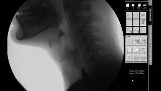 Honey Thick Liquids  Modified Barium Swallow Study MBSS Lateral View HD [upl. by Kermit]