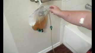 How Drain Urinary CATHETER BAG Release Pour Empty Remove Leg Urine Foley BARD Bardia Night Drainage [upl. by Nicole661]