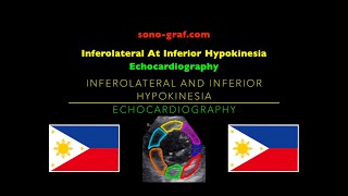 Echocardiography  Inferolateral At Inferior Hypokinesia [upl. by Shaun]