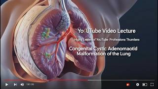 Fetal Anomalies Congenital Cystic Adenomatoid Malformation CCAM of The Lung [upl. by Godwin]