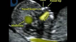 Fetal Medicine Foundation  Fetal profile [upl. by Anrym]