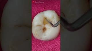 Small Teeth Cavities toothrestoration satisfying [upl. by Michel]