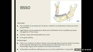 orthognathic surgery 2 [upl. by Osei]