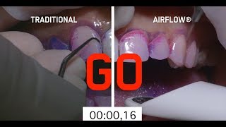 Abrasive teeth cleaning method vs AIRFLOW method [upl. by Ahsenauj]