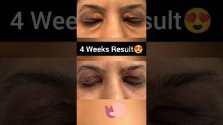 Xanthelasma Removal Before After  Xanthelasma Laser Removal Before and After [upl. by Okemak]