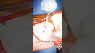 Removing Ganglion Cysts by zackdfilms removal pimplelife youtubeshorts facts viralvideo [upl. by Ahsen]