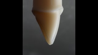 All Ceramic Crown Preparation for Emax and Zirconia [upl. by Kcirrez866]