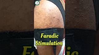 Shoulder Subluxation paralysis physio physiotherapy faradic dr drsuryakantsuryawanshi [upl. by Shieh]