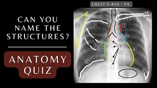 Chest Xray Anatomy Quiz Questions and Answers  Chest Xray Anatomy xray respiratory [upl. by Assirralc]