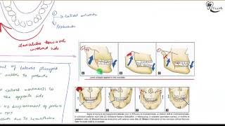 Condyle fracture Oral surgery [upl. by Athalia]