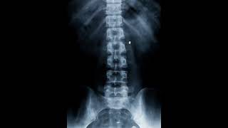 lumbar spine AP Xray  anatomy articular facets lamina pedicles psoas muscle [upl. by Secnirp]