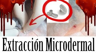 ☠ EXTRACCIÓN DE MICRODERMAL ☠ STORYTIME  VIDEO [upl. by Philippe]