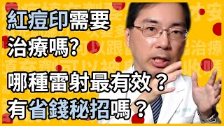 紅痘印 紅痘疤 需要治療嗎？消不掉怎麼辦？哪種雷射最有效？有省錢便宜高CP值的方法嗎？皮膚科醫師一次教你治療紅痘印的最強攻略！ [upl. by Sudnac563]