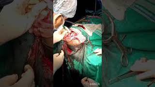 Craniotomy Procedure mbbsdairies mbbs aiimsdelhi biharmedicalcollege medico doctor [upl. by Star]