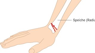 Die distale Radiusfraktur beim Erwachsenen [upl. by Anaujahs]