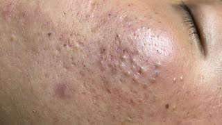 ACNE TREATMENT VU QUYNH MI  Blackheads Of Tweens 2024 EX [upl. by Bernie]