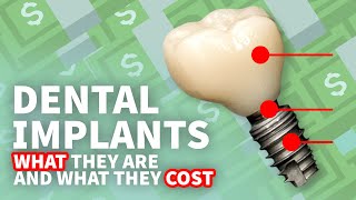 Dental Implants Cost Guide  9 Factors Influencing What You Pay [upl. by Arednaxela812]