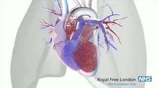 What is pulmonary hypertension [upl. by Atnoed218]