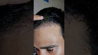 New Growth Baby Hair After Hair Transplant haircare newvideo result reels instagram hair [upl. by Linoel]