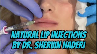 Natural Lip Injections with Juvederm Volbella [upl. by Bysshe]