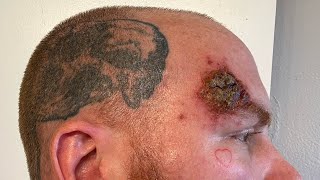 Week 5 Superficial Basal Cell Carcinoma Skin Cancer Aldara Treatment [upl. by Xela]