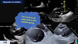 Tips amp Mistakes Artifacts amp Pathology Part 2 Reverberation [upl. by Reilamag237]