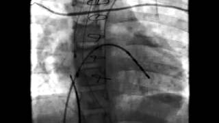 HandsOn Ablation Video 56 [upl. by Corbett]