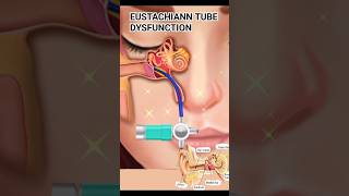 Eustachian Tube Dysfunction ear dysfunction treatment [upl. by Armitage]