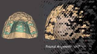 Palatal Augmentation Prosthesis for glossectomy case after removal of the tongue [upl. by Aralomo]