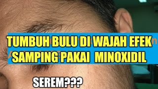 TERNYATA PAKAI MINOXIDIL DAN BIOTIN BAHAYA AUTO BERBULU minoxidil biotin [upl. by Rehpotsirhc]