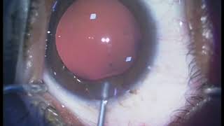 Phakic intraocular lens pIOL in cases of high myopia  Supplementary video ID 270690 [upl. by Tenay279]