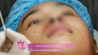 how to make nose smaller without surgery in minutes [upl. by Asilanom]