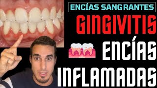 GINGIVITIS TRATAMIENTO y SÍNTOMAS  ENCIAS INFLAMADAS [upl. by Leziar683]