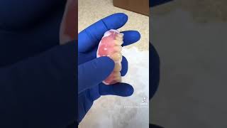 Immediate Denture Soft Reline [upl. by Eisserc]