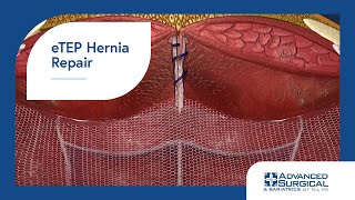 eTEP Hernia Repair [upl. by Fendig]