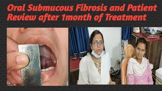 Oral Submucous Fibrosis and Patient Review after 1month of Treatment [upl. by Aman448]