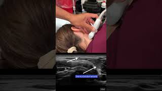 Spinal Accessory Nerve Block Scanning Technique [upl. by Brooks]