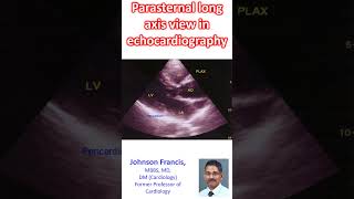 Parasternal long axis view in echocardiography [upl. by Nasho]