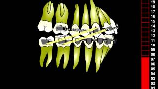 Orthodontie  Thérapeutique DAC  Distal Active Concept [upl. by Anomor]